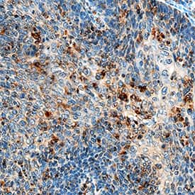 Hexokinase 1/2 was detected in immersion fixed paraffin-embedded sections of human cervical cancer tissue using Mouse Anti-Human Hexokinase 1/2 Monoclonal Antibody (Catalog # MAB8179) at 15 µg/mL overnight at 4 °C. Tissue was stained using the Anti-Mouse HRP-DAB Cell & Tissue Staining Kit (brown; Catalog # CTS002) and counterstained with hematoxylin (blue). Specific staining was localized to cytoplasm in cancer cells. View our protocol for Chromogenic IHC Staining of Paraffin-embedded Tissue Sections.
