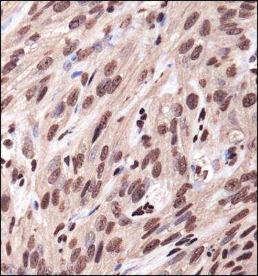 Immunohistochemistry-Paraffin: IGF-I R Antibody [NBP1-77679] -  IHC analysis of a formalin fixed paraffin embedded tissue section of the human kidney cancer xenograft using 1:200 dilution of IFG-I R antibody (NBP1-77679). The signal was developed using HRP-DAB method which followed counterstaining of the cells with hematoxylin.