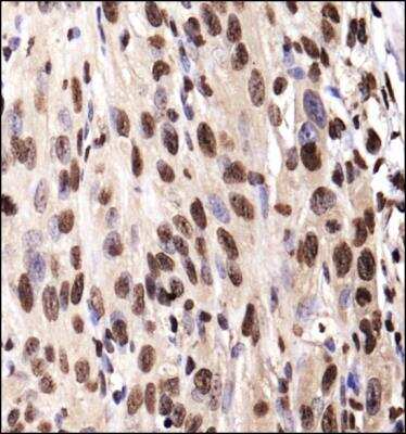 Immunohistochemistry-Paraffin: IGF-I R Antibody [NBP1-77680] - IHC analysis of a formalin fixed paraffin embedded tissue section of the human kidney cancer xenograft using 1:200 dilution of IFG-I R antibody (NBP1-77680). The signal was developed using HRP-DAB method which followed counterstaining of the cells with hematoxylin.