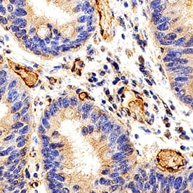 IGFBP-rp1/IGFBP-7 was detected in immersion fixed paraffin-embedded sections of human colon cancer tissue using Goat Anti-Human IGFBP-rp1/IGFBP-7 Biotinylated Antigen Affinity-purified Polyclonal Antibody (Catalog # BAF1334) at 15 µg/mL overnight at 4 °C. Before incubation with the primary antibody, tissue was subjected to heat-induced epitope retrieval using Antigen Retrieval Reagent-Basic (Catalog # CTS013). Tissue was stained using the Anti-Goat HRP-DAB Cell & Tissue Staining Kit (brown; Catalog # CTS008) and counterstained with hematoxylin (blue). Specific staining was localized to endothelial cells. View our protocol for Chromogenic IHC Staining of Paraffin-embedded Tissue Sections.