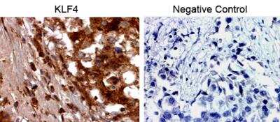 Immunohistochemistry-Paraffin: KLF4 Antibody [NBP2-24749] - Breast cancer tissues embedded in paraffin. Negative control is no primary antibody. Image from verified customer review.