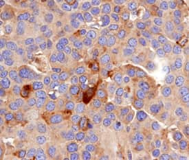 MDL-1/CLEC5A was detected in formalin fixed paraffin-embedded sections of human rheumatoid arthritis joint using Goat Anti-Human MDL-1/CLEC5A Antigen Affinity-purified Polyclonal Antibody (Catalog # AF2384) at 3 µg/mL overnight at 4 °C. Tissue was stained using the Anti-Goat HRP-DAB Cell & Tissue Staining Kit (brown; Catalog # CTS008) and counterstained with hematoxylin (blue). Specific staining was localized to plasma membranes of monocyte colony cells in rheumatoid arthritis joint. View our protocol for Chromogenic IHC Staining of Paraffin-embedded Tissue Sections.