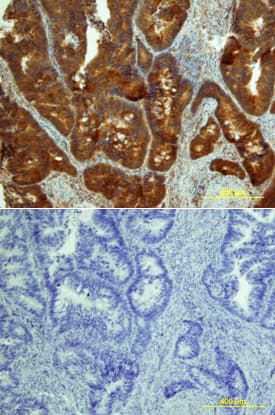 MICA was detected in immersion fixed paraffin-embedded sections of human colon array using Goat Anti-Human MICA Biotinylated Antigen Affinity-purified Polyclonal Antibody (Catalog # BAF1300) at 10 µg/mL overnight at 4 °C. Tissue was stained using the Anti-Goat HRP-DAB Cell & Tissue Staining Kit (brown; Catalog # CTS008) and counterstained with hematoxylin (blue). Lower panel shows a lack of labeling if primary antibodies are omitted and tissue is stained only with secondary antibody followed by incubation with detection reagents. View our protocol for Chromogenic IHC Staining of Paraffin-embedded Tissue Sections.
