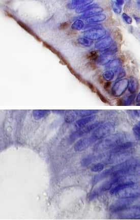 MLK4a was detected in immersion fixed paraffin-embedded sections of human colon cancer tissue using 10 &micro;g/mL Human/Mouse/Rat MLK4a Antigen Affinity-purified Polyclonal Antibody (Catalog # AF3435) overnight at 4 &deg;C. Before incubation with the primary antibody tissue was subjected to heat-induced epitope retrieval using Antigen Retrieval Reagent-Basic (Catalog # CTS013). Tissue was stained with the Anti-Rabbit HRP-DAB Cell & Tissue Staining Kit (brown; Catalog # CTS005) and counterstained with hematoxylin (blue). Specific labeling was localized to microvilli of epithelial cells. Lower panel shows a lack of labeling if primary antibodies are omitted and tissue is stained only with secondary antibody followed by incubation with detection reagents. View our protocol for Chromogenic IHC Staining of Paraffin-embedded Tissue Sections.