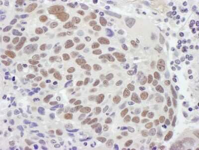 Immunohistochemistry-Paraffin: MSH2 Antibody [NB100-621] - Sample: FFPE section of human ovarian carcinoma. Antibody: Affinity purified rabbit anti-MSH2 used at a dilution of 1:1,000 (1ug/ml). Detection: DAB