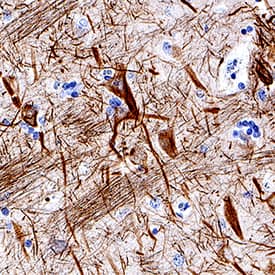   NF‑L  was detected in immersion fixed paraffin-embedded sections of human brain  (hippocampus) using Mouse Anti-Human/Mouse/Rat NF‑L Monoclonal Antibody  (Catalog # MAB22163) at 1.7 µg/mL for 1 hour at room  temperature followed by incubation with the Anti-Mouse IgG  VisUCyte™ HRP Polymer Antibody (Catalog # VC001).  Before incubation with the primary antibody, tissue was subjected to  heat-induced epitope retrieval using Antigen Retrieval Reagent-Basic (Catalog  # CTS013).  Tissue was stained using DAB (brown) and counterstained with hematoxylin  (blue). Specific staining was localized to neuronal cell bodies and  processes. View our protocol for IHC  Staining with VisUCyte HRP Polymer Detection Reagents.