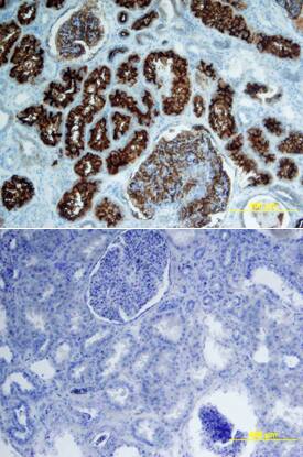 Neprilysin/CD10 was detected in immersion fixed paraffin-embedded sections of human kidney array using Goat Anti-Human Neprilysin/CD10 Biotinylated Antigen Affinity-purified Polyclonal Antibody (Catalog # BAF1182) at 15 µg/mL overnight at 4 °C. Tissue was stained using the Anti-Goat HRP-DAB Cell & Tissue Staining Kit (brown; Catalog # CTS008) and counterstained with hematoxylin (blue). Lower panel shows a lack of labeling if primary antibodies are omitted and tissue is stained only with secondary antibody followed by incubation with detection reagents. View our protocol for Chromogenic IHC Staining of Paraffin-embedded Tissue Sections.