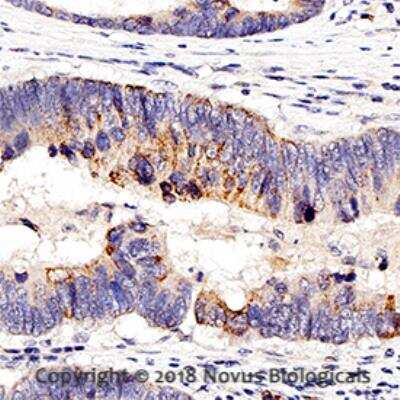 Immunohistochemistry-Paraffin: Nucleolin Antibody [NB100-1920] -  IHC analysis of a formalin fixed paraffin-embedded (FFPE) human colon cancer using 1:750 conc. of Nucleolin antibody on a Bond Rx autostainer (Leica Biosystems). The assay involved 20 minutes of heat induced antigen retrieval (HIER) using 10mM sodium citrate buffer (pH 6.0) and endogenous peroxidase quenching with peroxide block. The sections were incubated with primary antibody for 30 minutes and Bond Polymer Refine Detection (Leica Biosystems) with DAB was used for signal development followed by counterstaining with hematoxylin. Whole slide scanning and capturing of representative images (20X) was performed using Aperio AT2 (Leica Biosystems). Cytoplasmic staining was observed in normal cells and nuclear staining was observed in cancer cells. Staining was performed by Histowiz.