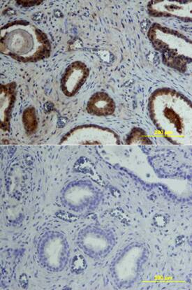 Osteoprotegerin/TNFRSF11B was detected in immersion fixed paraffin-embedded sections of human prostate array using Goat Anti-Human Osteoprotegerin/TNFRSF11B Biotinylated Antigen Affinity-purified Polyclonal Antibody (Catalog # BAF805) at 15 µg/mL overnight at 4 °C. Tissue was stained using the Anti-Goat HRP-DAB Cell & Tissue Staining Kit (brown; Catalog # CTS008) and counterstained with hematoxylin (blue). Lower panel shows a lack of labeling if primary antibodies are omitted and tissue is stained only with secondary antibody followed by incubation with detection reagents. View our protocol for Chromogenic IHC Staining of Paraffin-embedded Tissue Sections.