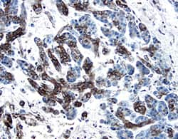 PDGF‑C was detected in immersion fixed paraffin-embedded sections of human pancreatic cancer tissue using 1.7 µg/mL Goat Anti-Human PDGF‑C Antigen Affinity-purified Polyclonal Antibody (Catalog # AF1560) overnight at 4 °C. Tissue was stained with the Anti-Goat HRP-DAB Cell & Tissue Staining Kit (brown; Catalog # CTS008) and counterstained with hematoxylin (blue). View our protocol for Chromogenic IHC Staining of Paraffin-embedded Tissue Sections.