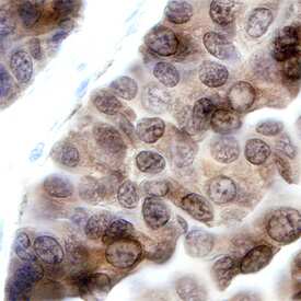 PKCe was detected in immersion fixed paraffin-embedded sections of human lung cancer tissue using Mouse Anti-Human PKCe Monoclonal Antibody (Catalog # MAB5134) at 15 µg/mL overnight at 4 °C. Before incubation with the primary antibody, tissue was subjected to heat-induced epitope retrieval using Antigen Retrieval Reagent-Basic (Catalog # CTS013). Tissue was stained using the Anti-Mouse HRP-DAB Cell & Tissue Staining Kit (brown; Catalog # CTS002) and counterstained with hematoxylin (blue). Specific staining was localized to cytoplasm and nuclei of cancer cells. View our protocol for Chromogenic IHC Staining of Paraffin-embedded Tissue Sections.