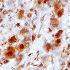 PSMA1 was detected in immersion fixed paraffin-embedded sections of human breast cancer tissue using Sheep Anti-Human/Mouse/Rat PSMA1 Antigen Affinity-purified Polyclonal Antibody (Catalog # AF7565) at 1.7 µg/mL overnight at 4 °C. Tissue was stained using the Anti-Sheep HRP-DAB Cell & Tissue Staining Kit (brown; Catalog # CTS019) and counterstained with hematoxylin (blue). Specific staining was localized to cytoplasm and nuclei. View our protocol for Chromogenic IHC Staining of Paraffin-embedded Tissue Sections.