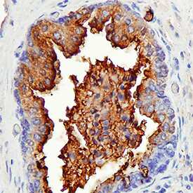 Patched 2/PTCH2 was detected in immersion fixed paraffin-embedded sections of human cervical cancer tissue using Mouse Anti-Human Patched 2/PTCH2 Monoclonal Antibody (Catalog # MAB4078) at 15 µg/mL overnight at 4 °C. Tissue was stained using the Anti-Mouse HRP-DAB Cell & Tissue Staining Kit (brown; Catalog # CTS002) and counterstained with hematoxylin (blue). Specific staining was localized to cytoplasm in epithelial cells. View our protocol for Chromogenic IHC Staining of Paraffin-embedded Tissue Sections.