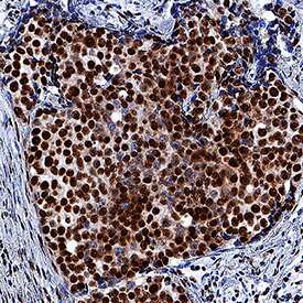         Retinoblastoma  Binding Protein 4  (RBBP4) was detected  in immersion fixed paraffin-embedded sections of human breast cancer tissue  using Mouse Anti-Human/Mouse/Rat RBBP4 Monoclonal Antibody (Catalog # MAB7416)  at 5 µg/mL for 1 hour at room temperature followed by  incubation with the Anti-Mouse IgG VisUCyte™  HRP Polymer Antibody (Catalog #  VC001).  Tissue was stained using DAB (brown) and counterstained with hematoxylin  (blue). Specific staining was localized to nuclei. View our protocol for  IHC  Staining with VisUCyte HRP Polymer Detection Reagents.  