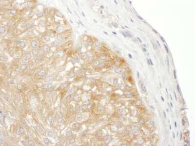 Immunohistochemistry-Paraffin: RPS9 Antibody [NBP2-22298] - Section of human ovarian carcinoma. Antibody: Affinity purified rabbit anti- RPS9 used at a dilution of 1:1,000 (1ug/ml). Detection: DAB. Counterstain: Hematoxylin (blue).