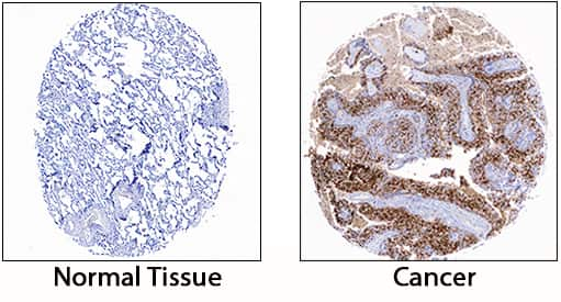         S100A8/S100A9  Heterodimer was detected in immersion fixed paraffin-embedded sections of  human lung cancer tissue using Rabbit Anti-Human S100A8/S100A9 Heterodimer  Monoclonal Antibody (Catalog # MAB45701) at 10 µg/mL for 1  hour at room temperature followed by incubation with the Anti-Rabbit IgG  VisUCyte™ HRP Polymer Antibody (Catalog # VC003).  Tissue was stained using DAB (brown) and counterstained with hematoxylin  (blue).  Specific staining was  localized to cytoplasm in tumor cells. View our protocol for IHC  Staining with VisUCyte HRP Polymer Detection Reagents.  