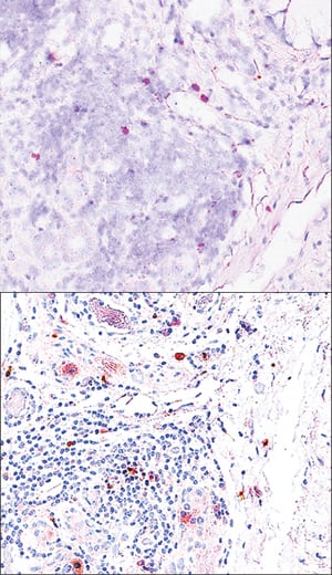 <b>Orthogonal Strategies Validation. </b>Syndecan-1/CD138 mRNA was detected (top image)in formalin-fixed paraffin-embedded tissue sections of human metastatic tonsilcancer tissue probed with ACD RNAScope® Probe (Catalog # 425271) and stainedusing ACD RNAscope® 2.5 HD Duplex Detection Reagents (red, Catalog # 322500).Adjacent tissue section (bottom image) was processed for immunohistochemistry using R&DSystems Rabbit Anti-Human S100A8/S100A9 Monoclonal Antibody (Catalog# MAB45701)at 5 ug/mL for 1 hour at room temperature followed by incubation with the Anti-RabbitIgG VisUCyte HRP Polymer Antibody (R&D Systems, Catalog # VC003) and DABchromogen (brown). Tissues were counterstained with hematoxylin (blue). 