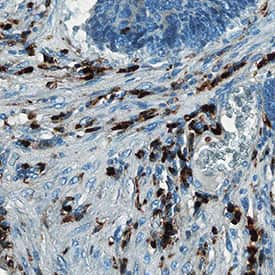 S100A8/S100A9 Heterodimer was detected in immersion fixed paraffin-embedded sections of human colon cancer tissue using Mouse Anti-Human S100A8/S100A9 Heterodimer Monoclonal Antibody (Catalog # MAB45702) at 15 µg/mL for 1 hour at room temperature followed by incubation with the Anti-Mouse IgG VisUCyte™ HRP Polymer Antibody (VC001). Tissue was stained using DAB (brown) and counterstained with hematoxylin (blue). Specific staining was localized to connective tissue fibroblasts. View our protocol for IHC Staining with VisUCyte HRP Polymer Detection Reagents.