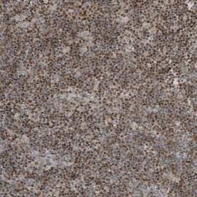 Immunohistochemistry-Paraffin: SOX11 Antibody [NBP1-85823] - Staining of human mantle cell lymphoma shows moderate to strong nuclear positivity in tumor cells.