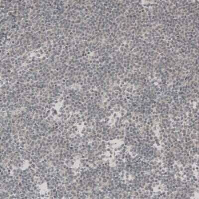 Immunohistochemistry-Paraffin: SOX11 Antibody [NBP1-85823] - Staining of human chronic lymphocytic leukemia shows no nuclear positivity in tumor cells as expected.