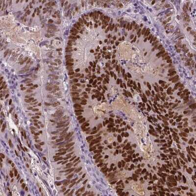 Immunohistochemistry-Paraffin: SOX9 Antibody [NBP1-85551] - Staining of human colorectal cancer shows moderate to strong nuclear positivity in tumor cells.