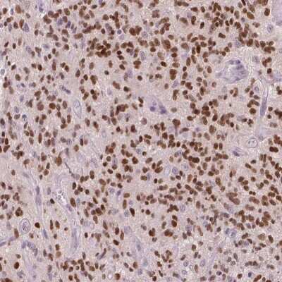 Immunohistochemistry-Paraffin: SOX9 Antibody [NBP1-85551] - Staining of human glioma shows moderate to strong nuclear positivity in tumor cells.