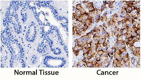         Sushi  Domain Containing 2 (SUSD2) was detected in immersion fixed paraffin-embedded  sections of human breast cancer tissue using Rabbit Anti-Human SUSD2  Monoclonal Antibody (Catalog # MAB90562)  at 3 µg/mL for 1 hour at room temperature followed by  incubation with the Anti-Rabbit IgG VisUCyte™ HRP Polymer Antibody  (Catalog # VC003).  Tissue was stained using DAB (brown) and counterstained with hematoxylin  (blue). Specific staining was localized to cytoplasm in cancer cells. View  our protocol for IHC  Staining with VisUCyte HRP Polymer Detection Reagents.  