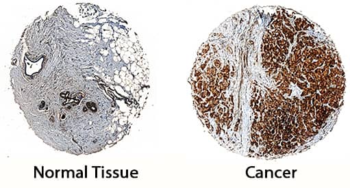 SUSD2 was detected in immersion fixed paraffin-embedded sections of human breast cancer tissue using Mouse Anti-Human SUSD2 Monoclonal Antibody (Catalog # MAB9056) at 15 µg/mL overnight at 4 °C. Tissue was stained using the Anti-Mouse HRP-DAB Cell & Tissue Staining Kit (brown; Catalog # CTS002) and counterstained with hematoxylin (blue). Specific staining was localized to cytoplasm with higher expression in cancer tissue. View our protocol for Chromogenic IHC Staining of Paraffin-embedded Tissue Sections.