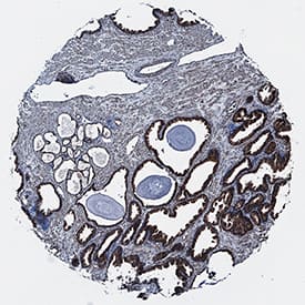 TRIM32 was detected in immersion fixed paraffin-embedded sections of human prostate cancer tissue using Sheep Anti-Human/Mouse TRIM32 Antigen Affinity-purified Polyclonal Antibody (Catalog # AF6515) at 10 µg/mL overnight at 4 °C. Tissue was stained using the Anti-Sheep HRP-DAB Cell & Tissue Staining Kit (brown; Catalog # CTS019) and counterstained with hematoxylin (blue). Specific staining was localized to cytoplasm in epithelial cells. View our protocol for Chromogenic IHC Staining of Paraffin-embedded Tissue Sections.