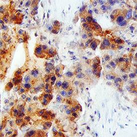 VEGF was detected in immersion fixed paraffin-embedded sections of human liver using Recombinant Mouse Anti-Human/Primate VEGF Monoclonal Antibody (Catalog # MAB293R) at 15 µg/mL overnight at 4 °C. Tissue was stained using the Anti-Mouse HRP-DAB Cell & Tissue Staining Kit (brown; Catalog # CTS002) and counterstained with hematoxylin (blue). Specific staining was localized to cytoplasm in hepatocytes. View our protocol for Chromogenic IHC Staining of Paraffin-embedded Tissue Sections.