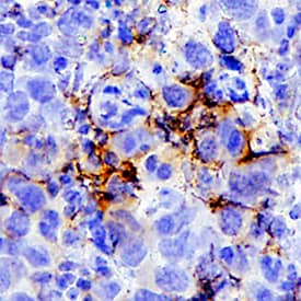 LILRB2/CD85d/ILT4 was detected in immersion fixed paraffin-embedded sections of Human Malignant Lymph Node using Goat Anti-Human LILRB2/CD85d/ILT4 Antigen Affinity-purified Polyclonal Antibody (Catalog # AF2078) at 3 µg/mL for 1 hour at room temperature followed by incubation with the Anti-Goat IgG VisUCyte™ HRP Polymer Antibody (Catalog # VC004). Before incubation with the primary antibody, tissue was subjected to heat-induced epitope retrieval using VisUCyte Antigen Retrieval Reagent-Basic (Catalog # VCTS021). Tissue was stained using DAB (brown) and counterstained with hematoxylin (blue). Specific staining was localized to cell surface. View our protocol for IHC Staining with VisUCyte HRP Polymer Detection Reagents.