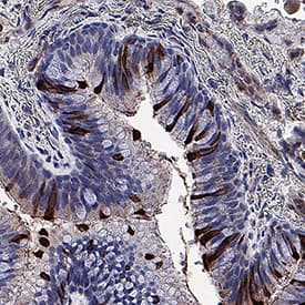 Spike S1 Subunit was detected in immersion fixed paraffin-embedded sections of Human lung infected with SARS delta variant using Mouse Anti-SARS-CoV-2 Spike S1 Subunit Monoclonal Antibody (Catalog # MAB105403) at 5 µg/mL for 1 hour at room temperature followed by incubation with the Anti-Mouse IgG VisUCyte™ HRP Polymer Antibody (Catalog # VC001). Before incubation with the primary antibody, tissue was subjected to heat-induced epitope retrieval using VisUCyte Antigen Retrieval Reagent-Basic (Catalog # VCTS021). Tissue was stained using DAB (brown) and counterstained with hematoxylin (blue). Specific staining was localized to cytoplasm in bronchial epithelial cells. View our protocol for IHC Staining with VisUCyte HRP Polymer Detection Reagents.