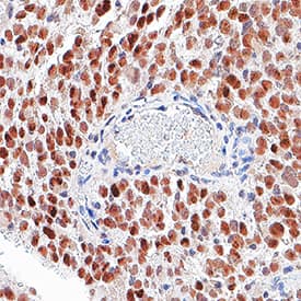 SOX2 was detected in immersion fixed paraffin-embedded sections of glioblastoma using Mouse Anti-Human/Mouse/Rat SOX2 Monoclonal Antibody (Catalog # MAB2018R) at 5 µg/mL for 1 hour at room temperature followed by incubation with the Anti-Mouse IgG VisUCyte™ HRP Polymer Antibody (Catalog # VC001). Before incubation with the primary antibody, tissue was subjected to heat-induced epitope retrieval using VisUCyte Antigen Retrieval Reagent-Basic (Catalog # VCTS021). Tissue was stained using DAB (brown) and counterstained with hematoxylin (blue). Specific staining was localized to nuclei in cancer cells. View our protocol for IHC Staining with VisUCyte HRP Polymer Detection Reagents.