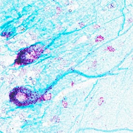 NEFL mRNA (red) and protein (green/blue) was detected in formalin-fixed paraffin-embedded tissue sections of human cerebellum. ACD’s Integrated Co-Detection Workflow was performed using ACD RNAScope Probe Hs-NEFL (Catalog # 468671) and mouse anti-human NEFL monoclonal antibody (R&D Systems Catalog #MAB22161) at 5 µg/mL. Tissue was stained using RNAscope® 2.5 HD Detection Reagents-RED (Catalog # 322360), Mouse IgG VisUCyte HRP Polymer Antibody (Catalog # VC001) and and RNAscope® 2.5 LS Green Accessory Pack (Catalog #322550). Tissue was counterstained with 50% hematoxylin (purple).