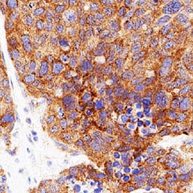 Thrombopoietin/Tpo was detected in immersion fixed paraffin-embedded sections of breast cancer using Mouse Anti-Human Thrombopoietin/Tpo Monoclonal Antibody (Catalog # MAB2882) at 5 µg/mL for 1 hour at room temperature followed by incubation with the Anti-Mouse IgG VisUCyte™ HRP Polymer Antibody (Catalog # VC001). Before incubation with the primary antibody, tissue was subjected to heat-induced epitope retrieval using VisUCyte Antigen Retrieval Reagent-Basic (Catalog # VCTS021). Tissue was stained using DAB (brown) and counterstained with hematoxylin (blue). Specific staining was localized to cytoplasm and cell surface of cancer cells. View our protocol for IHC Staining with VisUCyte HRP Polymer Detection Reagents.