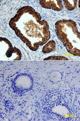 p63/TP73L was detected in immersion fixed paraffin-embedded sections of human prostate array using Goat Anti-Human p63/TP73L Biotinylated Antigen Affinity-purified Polyclonal Antibody (Catalog # BAF1916) at 15 µg/mL overnight at 4 °C. Tissue was stained using the Anti-Goat HRP-DAB Cell & Tissue Staining Kit (brown; Catalog # CTS008) and counterstained with hematoxylin (blue). Lower panel shows a lack of labeling if primary antibodies are omitted and tissue is stained only with secondary antibody followed by incubation with detection reagents. View our protocol for Chromogenic IHC Staining of Paraffin-embedded Tissue Sections.